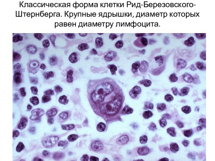 Классическая форма клетки Рид-Березовского-Штернберга. Крупные ядрышки, диаметр которых равен диаметру лимфоцита.
