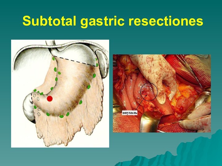 Subtotal gastric resectiones