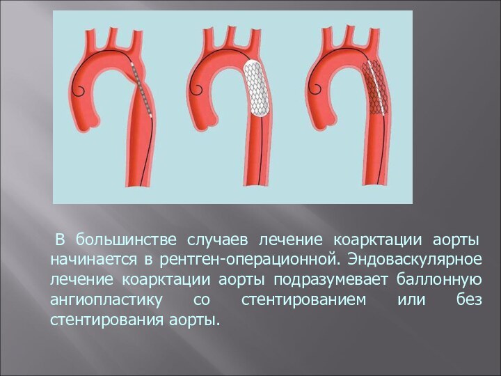  В большинстве случаев лечение коарктации аорты начинается в рентген-операционной. Эндоваскулярное лечение коарктации