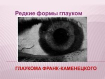 Глаукома Франк-Каменецкого. Редкие формы глауком