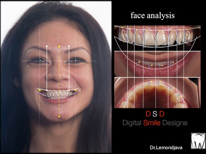 face analysisD S D Digital Smile DesigneDr.Lemondjava