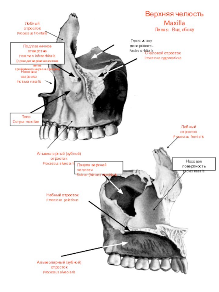 Верхняя челюсть MaxillaЛевая  Вид сбокуТелоCorpus maxillaeЛобный отростокProcessus frontalisГлазничная поверхностьFacies orbitalisСкуловой отростокProcessus