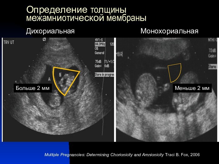 Определение толщины межамниотической мембраныMultiple Pregnancies: Determining Chorionicity and Amnionicity Traci B. Fox,
