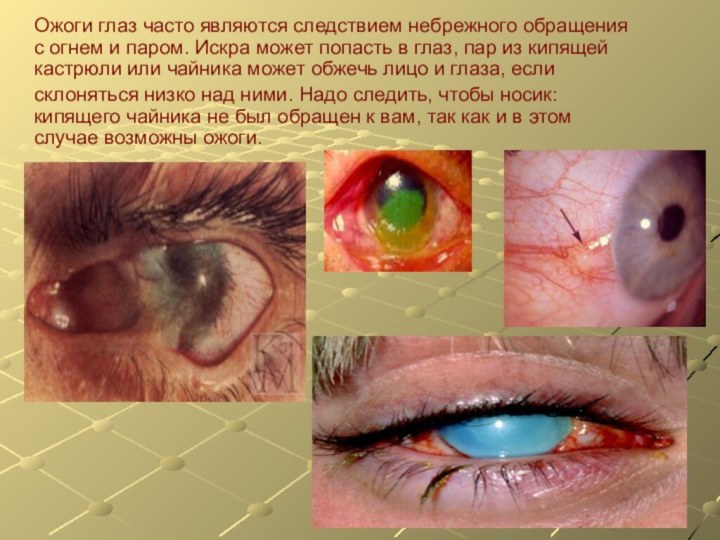 Ожоги глаз часто являются следствием небрежного обращения с огнем