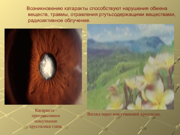 Возникновению катаракты способствуют нарушения обмена веществ, травмы, отравления ртутьсодержащими