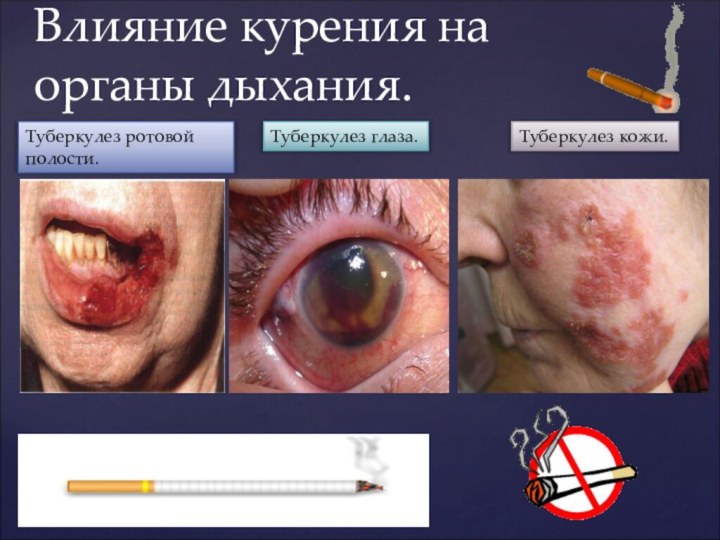 Влияние курения на органы дыхания.Туберкулез ротовой полости.Туберкулез глаза.Туберкулез кожи.