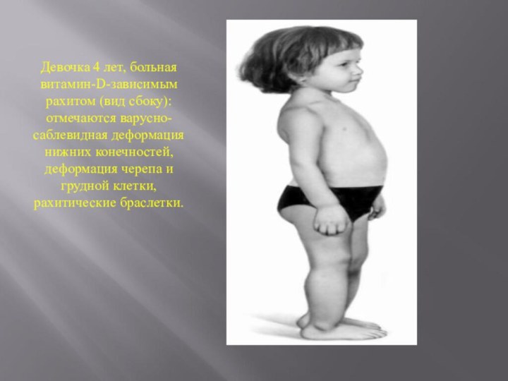 Девочка 4 лет, больная витамин-D-зависимым рахитом (вид сбоку): отмечаются варусно-саблевидная деформация нижних конечностей, деформация