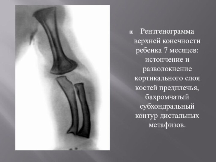 Рентгенограмма верхней конечности ребенка 7 месяцев: истончение и разволокнение кортикального слоя костей предплечья, бахромчатый