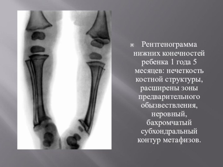 Рентгенограмма нижних конечностей ребенка 1 года 5 месяцев: нечеткость костной структуры, расширены зоны предварительного