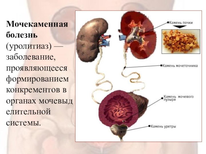 Мочекаменная болезнь (уролитиаз) — заболевание, проявляющееся формированием конкрементов в органах мочевыделительной системы.