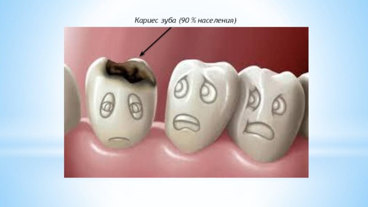 Кариес зуба (90 % населения)