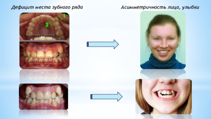 Дефицит места зубного рядаАсимметричность лица, улыбки