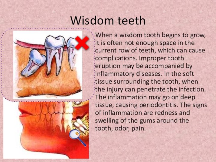 Wisdom teethWhen a wisdom tooth begins to grow, it is often not