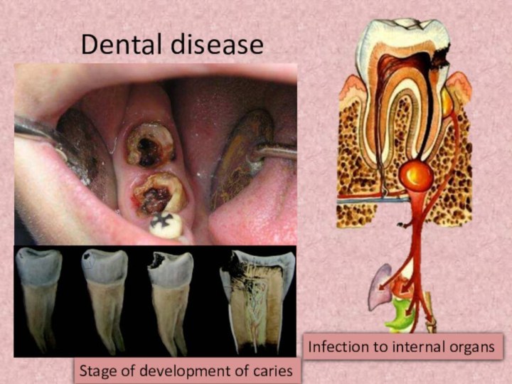 Dental diseaseStage of development of cariesInfection to internal organs