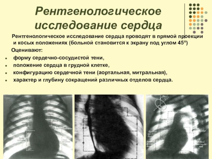 Рентгенологическое исследование сердца  Рентгенологическое исследование сердца проводят в прямой проекции и косых положениях
