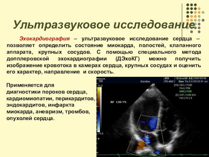 Ультразвуковое исследование    Эхокардиография – ультразвуковое исследование сердца