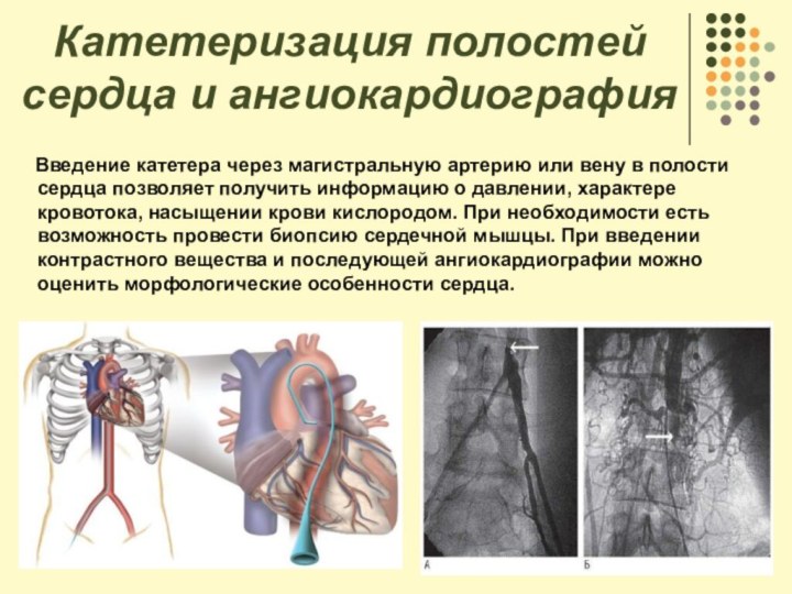 Катетеризация полостей сердца и ангиокардиография   Введение катетера через магистральную артерию или вену