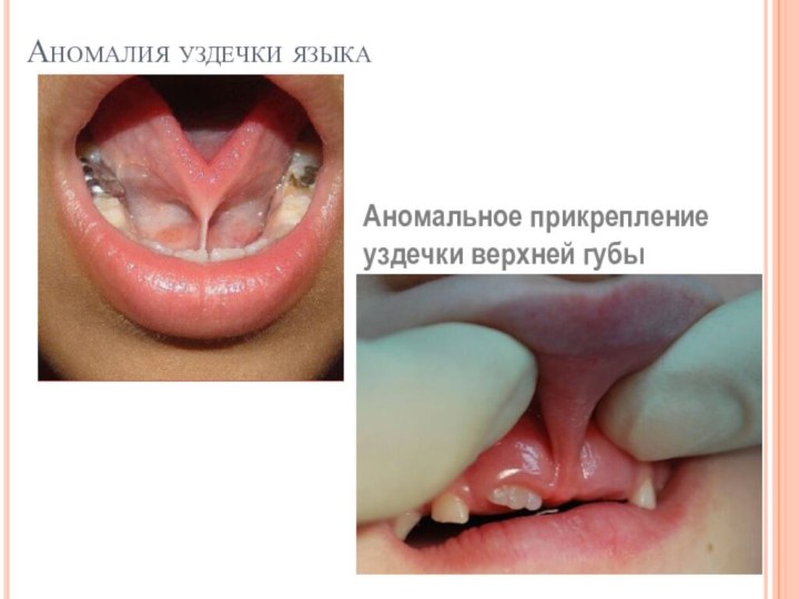 Аномалия уздечки языкаАномальное прикрепление уздечки верхней губы