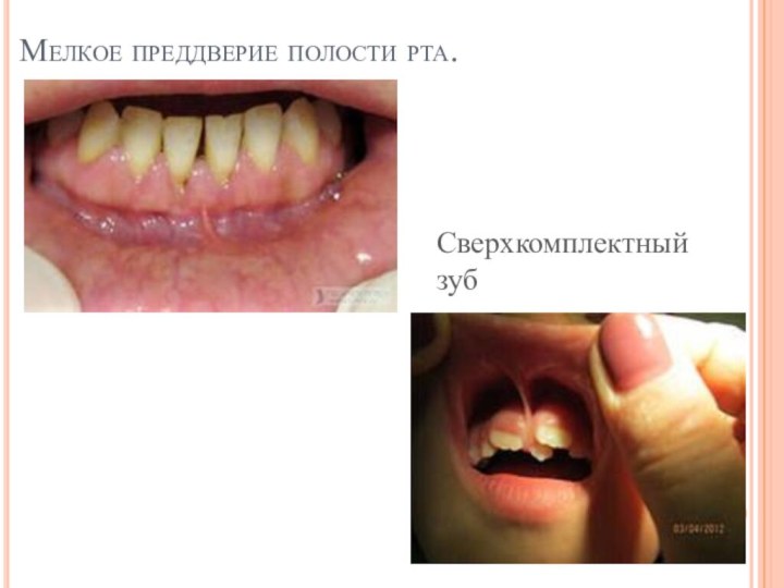 Мелкое преддверие полости рта.Сверхкомплектный зуб