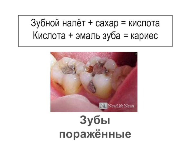 Зубы поражённые кариесом.